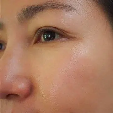 Close-up of person's face showing skin texture and eye area for dental or cosmetic assessment.