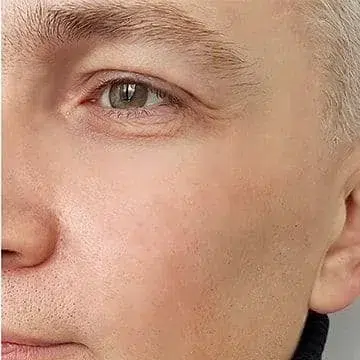 Close-up of male face showing skin texture and facial features in neutral lighting.