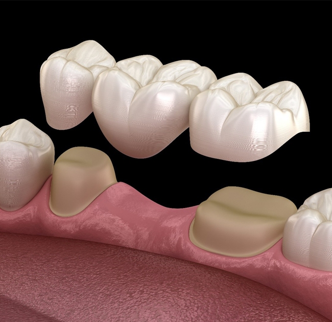 Dental bridge restoration showing ceramic tooth replacements positioned over pink gum model.
