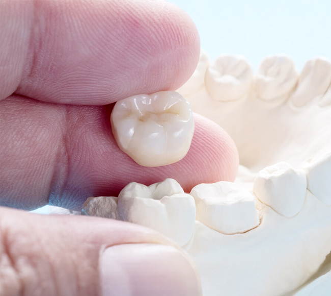 Hand holding dental crown model with additional tooth restorations on white surface.