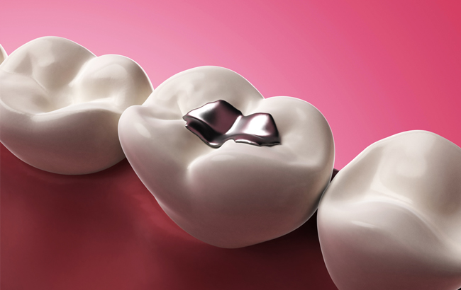 White dental models showing tooth cavity and treatment against pink background for Marion DDS dental practice.