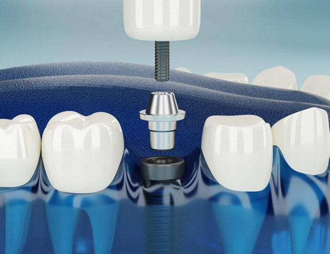 Dental implant cross-section showing artificial tooth anchored in jawbone with natural teeth alongside.