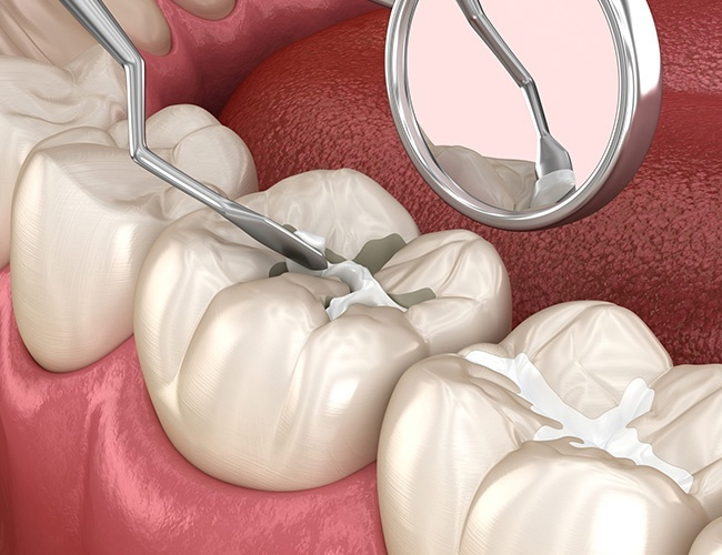 Dental model showing tooth preparation and restoration with mirror and instruments on red surface.
